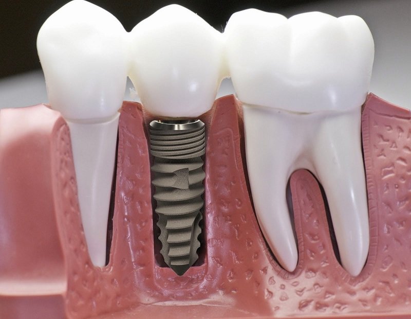 Cấy ghép implant mất bao lâu? Hành trình phục hồi nụ cười vững bền cay ghep implant gia bao nhieu 1