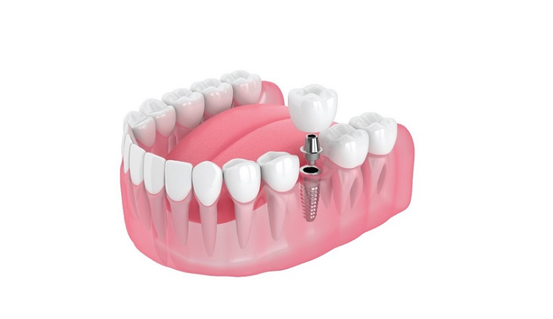 Cấy ghép implant mất bao lâu? Hành trình phục hồi nụ cười vững bền cay ghep implant gia bao nhieu 2