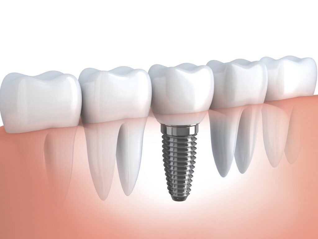Cấy ghép implant mất bao lâu? Hành trình phục hồi nụ cười vững bền Cấy ghép implant mất bao lâu