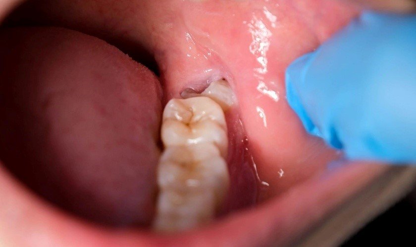 Dấu hiệu răng khôn mọc lệch