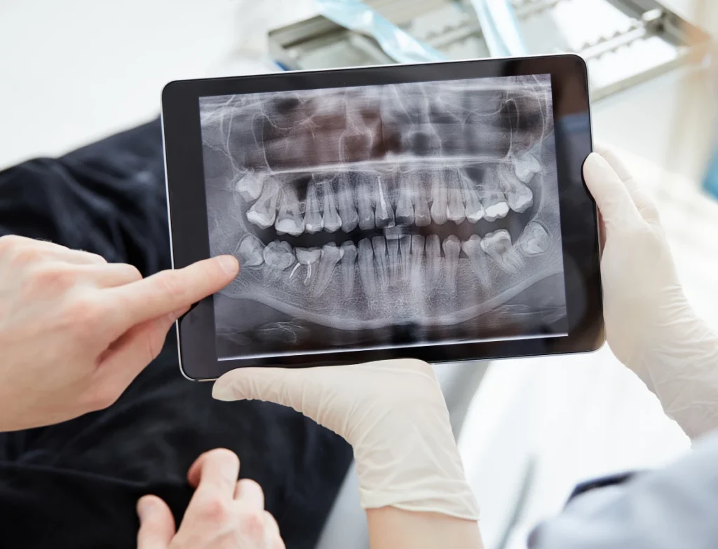 Làm răng implant giá bao nhiêu? Cập nhật chi phí chi tiết thực tế 2025 densmi 59