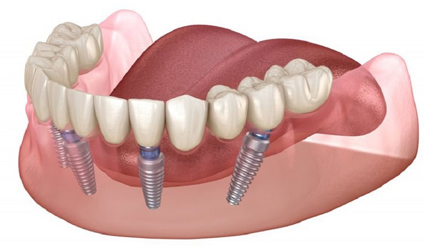 Trồng răng hàm implant giá bao nhiêu? Xem ngay bảng giá chi tiết 2025 gia lam rang gia nguyen ham 2