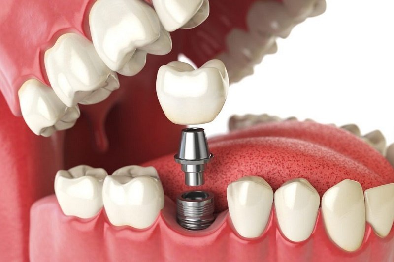 Giá làm răng sứ implant: Cập nhật bảng giá mới nhất và điều cần biết gia lam rang su implant 1