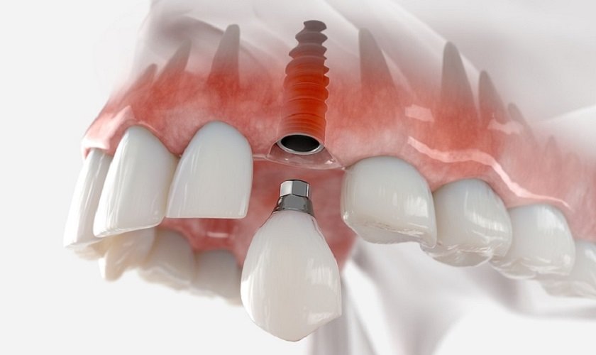 Giá trồng răng implant ở Hà Nội: Cập nhật chi tiết, tư vấn chuyên sâu gia trong rang implant o ha noi 1
