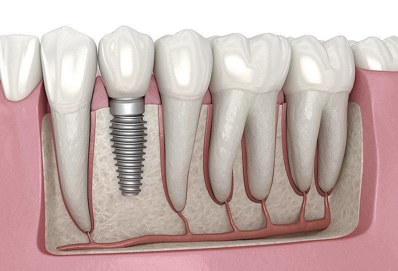 Giá trồng răng implant ở Hà Nội: Cập nhật chi tiết, tư vấn chuyên sâu gia trong rang implant o ha noi 2