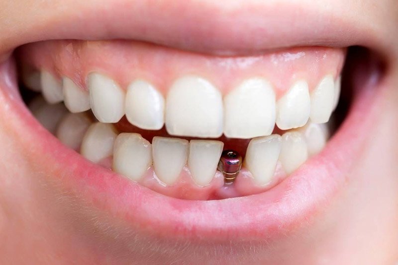 gia trong rang implant o ha noi