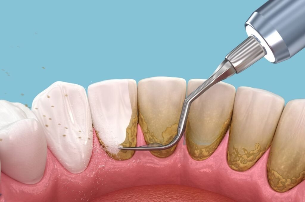 Lấy cao răng có đau không? Giải đáp và cách giảm ê buốt hiệu quả lay cao rang co dau khong 2