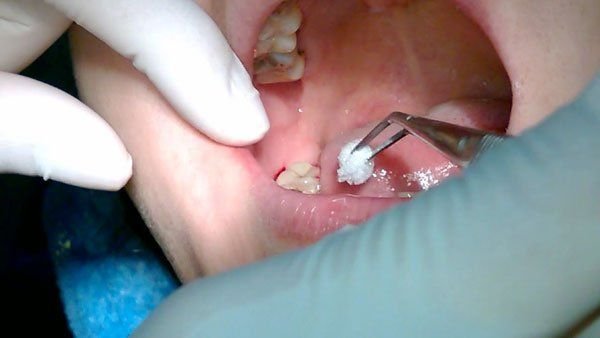 Nhổ răng khôn kiêng ăn gì để nhanh lành, không đau, tránh biến chứng? nho ran khong kieng an gi 1 1