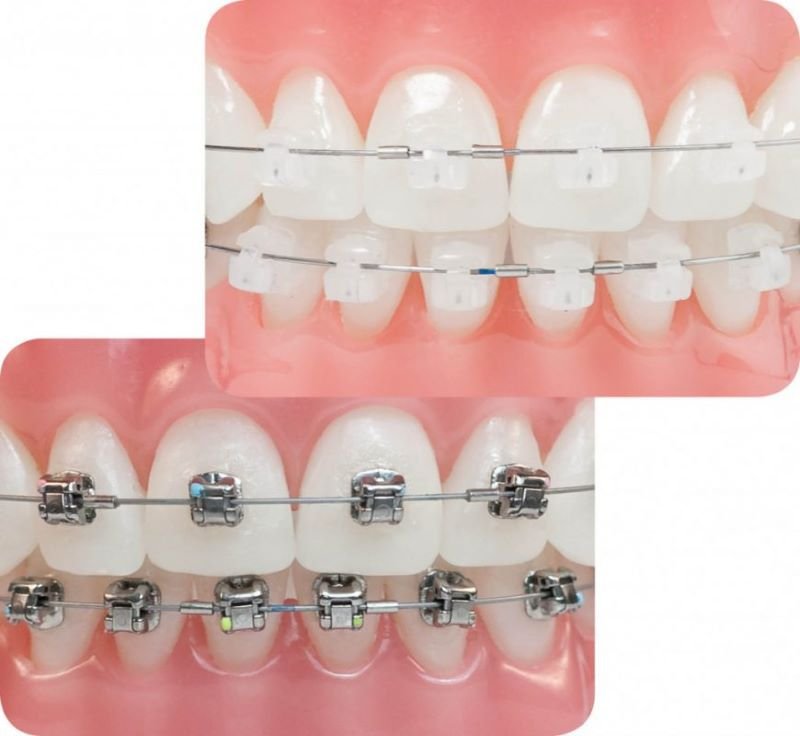 Niềng Răng Mắc Cài Tự Buộc Là Gì? Ưu Nhược Điểm & Chi Phí Chi Tiết Niềng răng mắc cài tự buộc