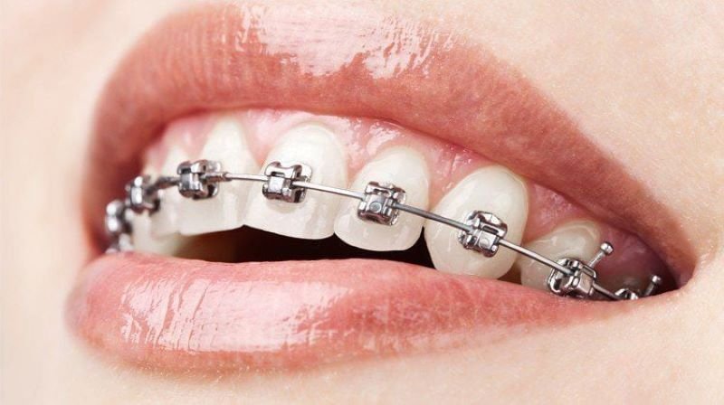 Niềng Răng Mắc Cài Tự Buộc Là Gì? Ưu Nhược Điểm & Chi Phí Chi Tiết Niềng răng mắc cài tự buộc