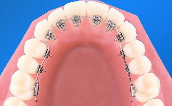 Giải đáp chi tiết: Niềng răng mắc cài kim loại bao nhiêu tiền Niềng răng mắc cài kim loại bao nhiêu tiền