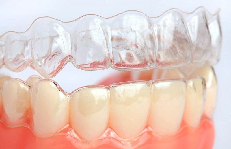 Niềng Răng Trong Suốt Mất Bao Lâu ? Có Nhanh Hơn Mắc Cài Không? Niềng răng trong suốt mất bao lâu