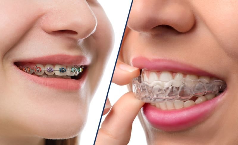 Niềng Răng Trong Suốt Mất Bao Lâu ? Có Nhanh Hơn Mắc Cài Không? So sánh niềng răng trong suốt và niềng răng mắc cài
