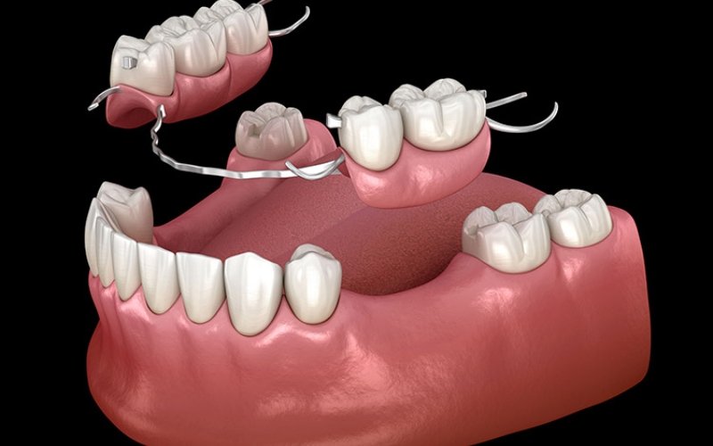 Trồng răng giả tháo lắp là gì? Ai nên làm và giá bao nhiêu? trong rang gia thao lap 1