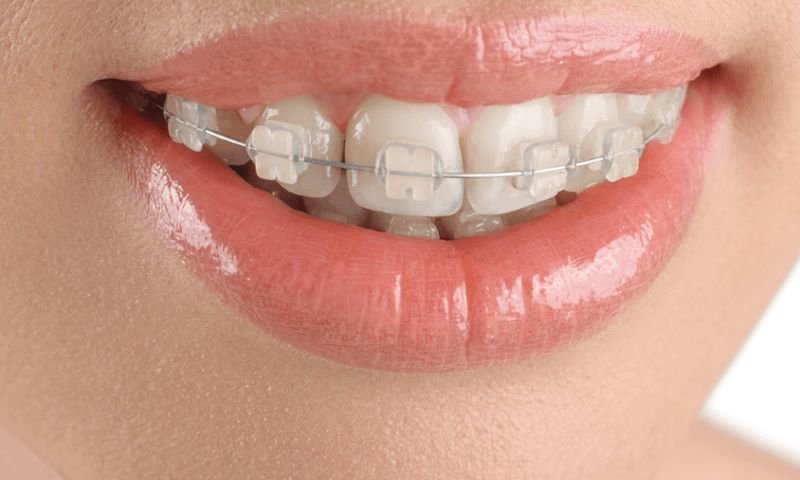 Niềng răng mắc cài trong suốt là gì? So sánh niềng khay trong suốt? Niềng răng mắc cài trong suốt