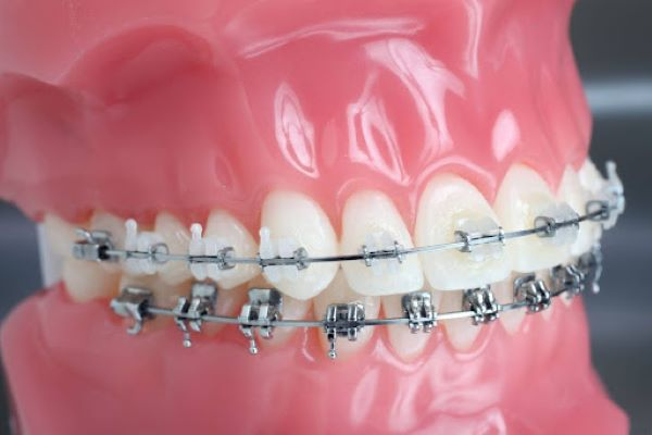 Chi phí niềng răng mắc cài kim loại là bao nhiêu? Bảng giá chi tiết. Chi phí niềng răng mắc cài kim loại