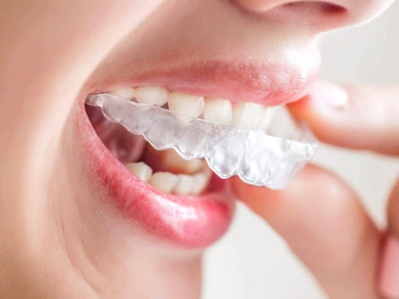 Niềng răng trong suốt mất bao lâu