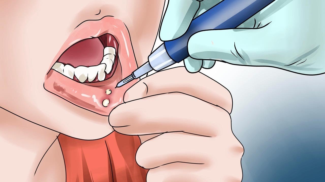 Cách Trị Nhiệt Miệng Trong 1 Ngày Hiệu Quả Và Dễ Áp Dụng cach tri nhit mieng trong 1 ngay