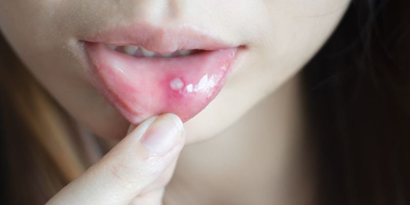 Cách Trị Nhiệt Miệng Trong 1 Ngày Hiệu Quả Và Dễ Áp Dụng cach tri nhit mieng trong 1 ngay