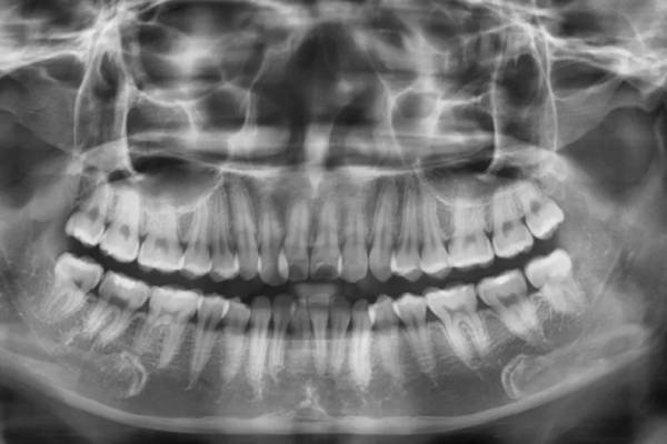 Nhổ răng số 8 có nguy hiểm không
