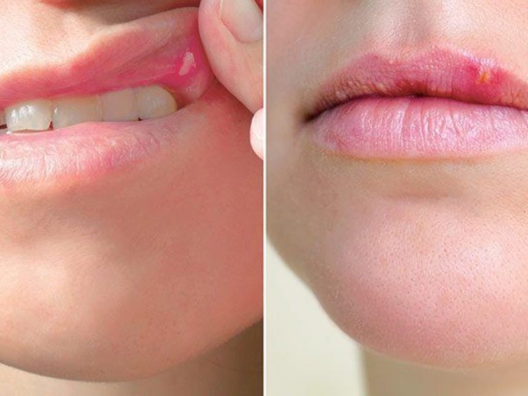 Tại sao bị nhiệt miệng liên tục