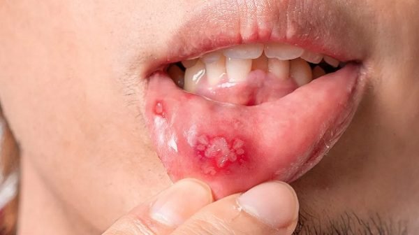 Tại sao bị nhiệt miệng liên tục