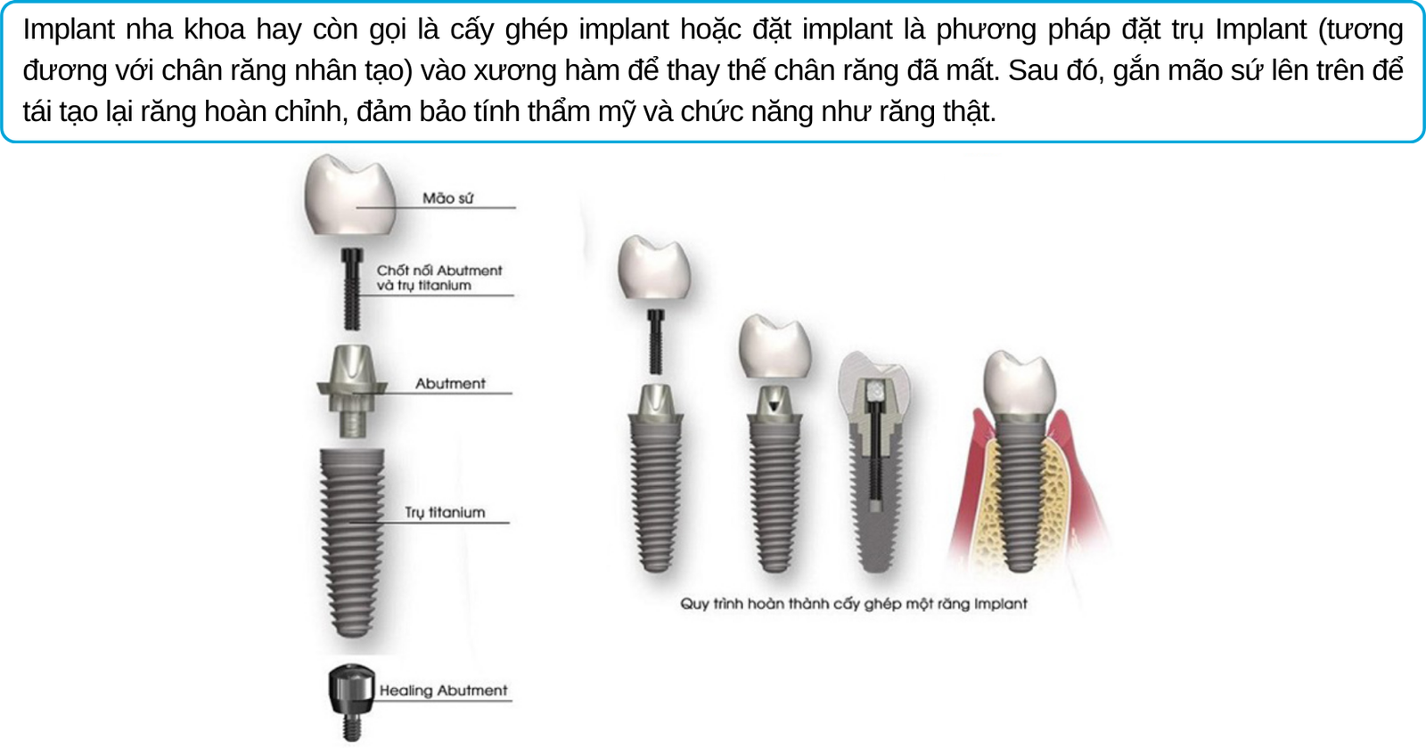 Giá làm răng sứ implant​