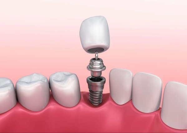 Giá làm răng sứ implant​