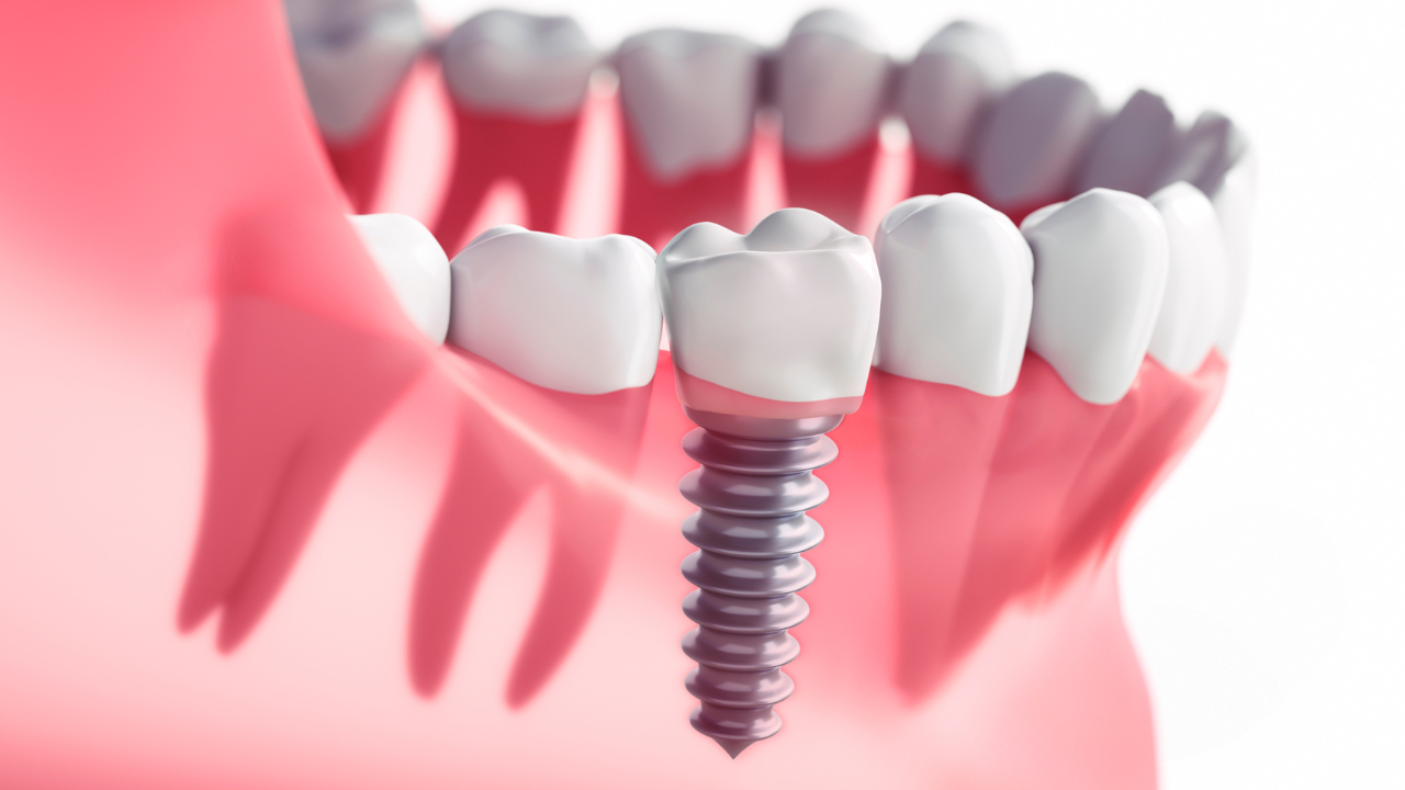 Giá làm răng sứ implant​