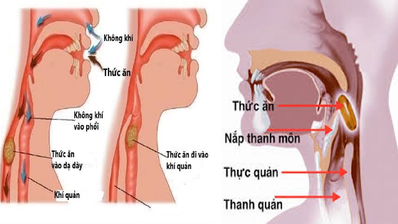 Cách trị hóc xương cá ở cổ họng tại nhà: Hướng dẫn an toàn và dễ hiểu Cách trị hóc xương cá ở cổ họng tại nhà