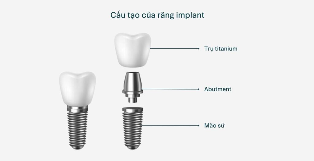 Cấy ghép implant giá bao nhiêu​
