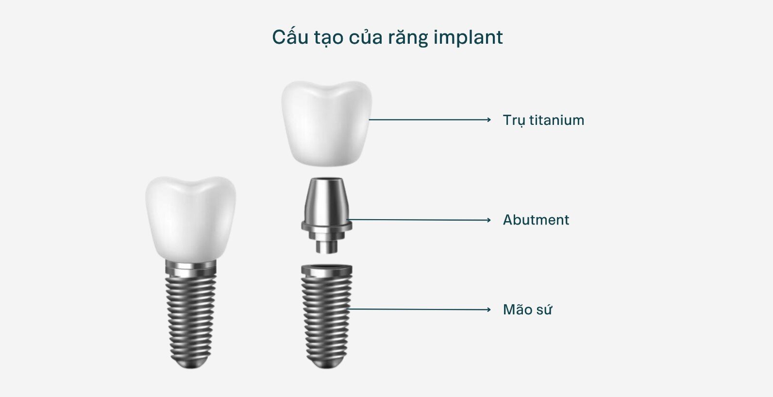 Cấy ghép implant giá bao nhiêu​