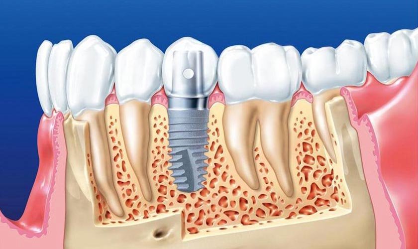 Cấy ghép implant giá bao nhiêu​