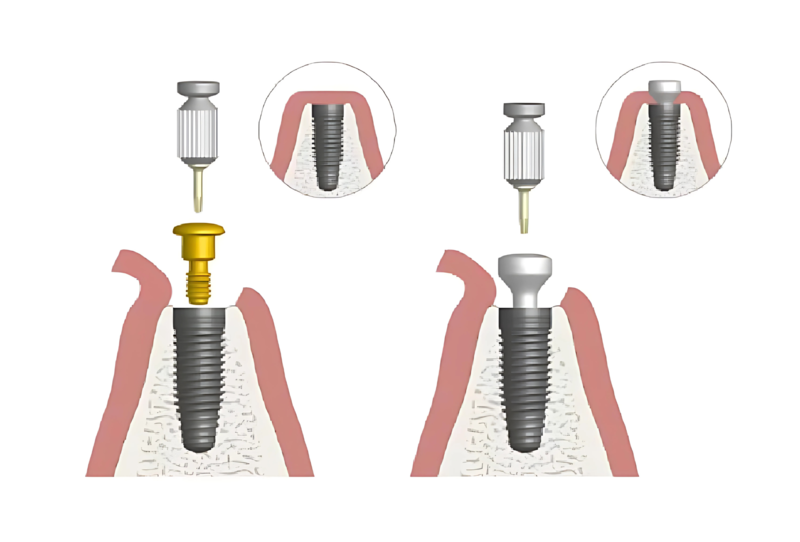 Cấy ghép implant mất bao lâu