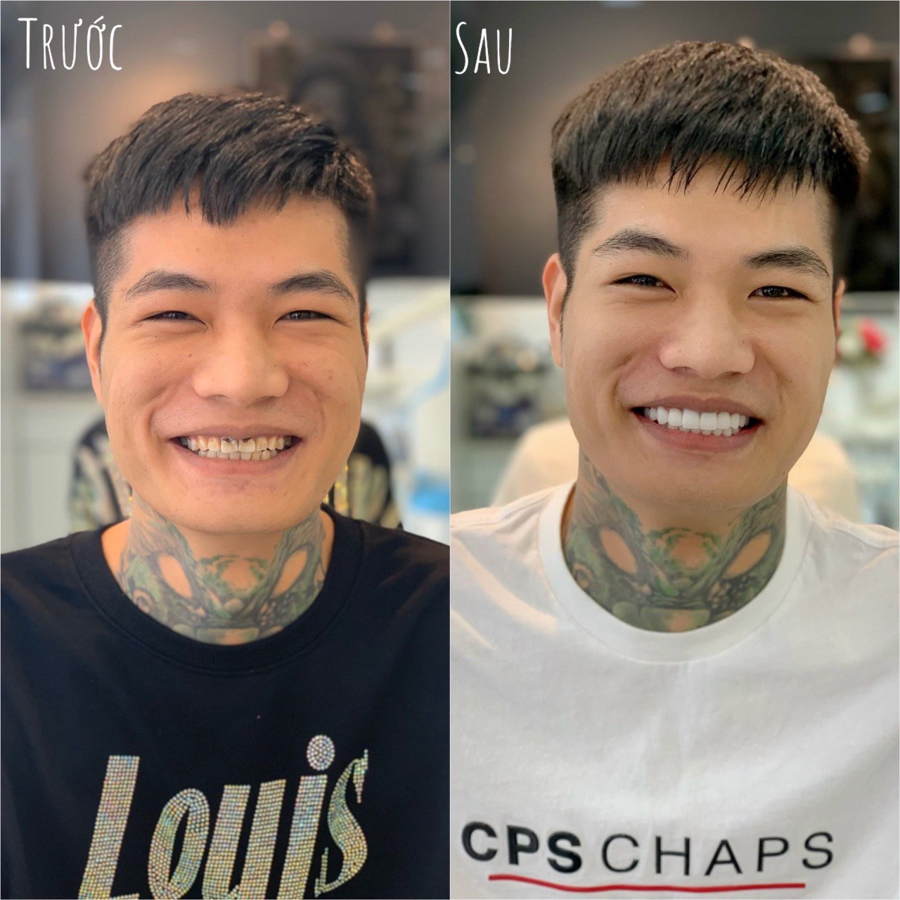 Trồng Răng Hàm Implant Giá Bao Nhiêu Và Thời Gian Hồi Phục trồng răng hàm implant giá bao nhiêu