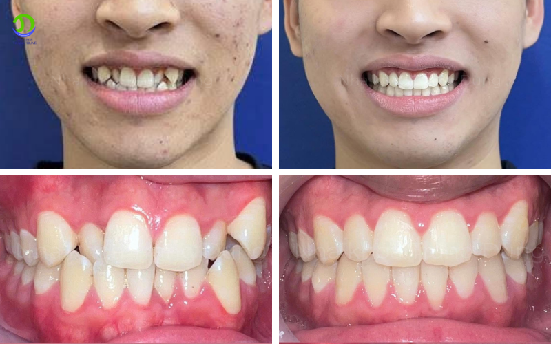ảnh trước sau của bệnh nhân niềng răng khấp khểnh