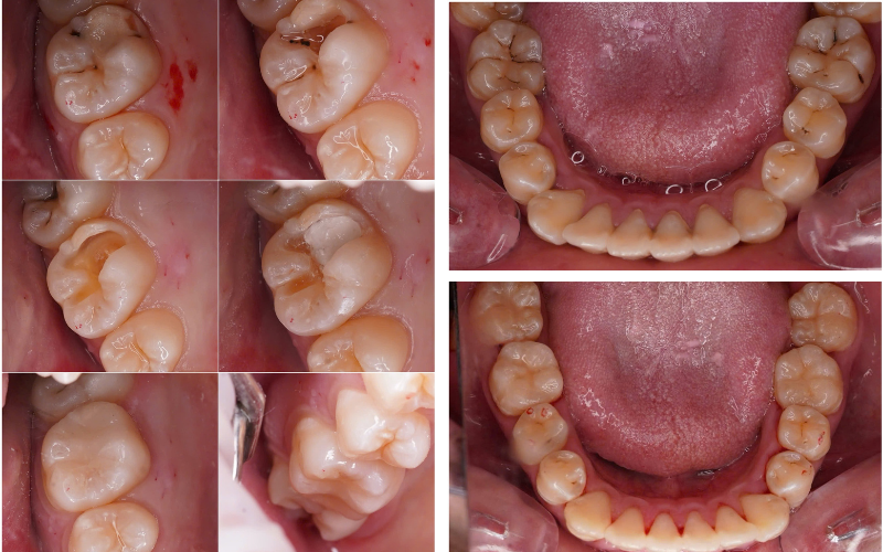 7 mức độ nguy hiểm khi sâu răng tới tủy – Viêm tủy răng có thể gây hậu quả gì? sâu răng