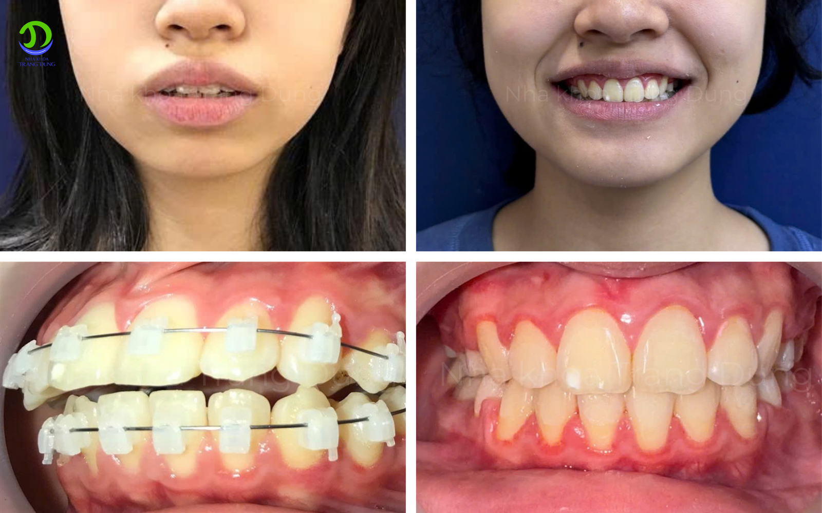 trước và sau khi niềng răng bị hô 