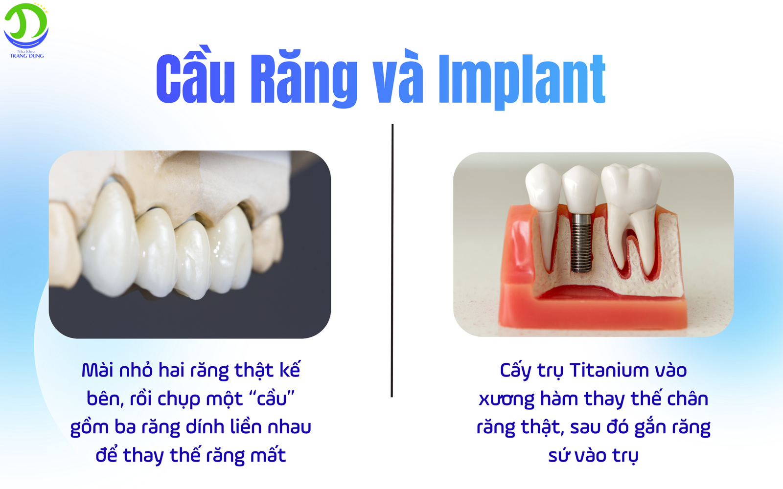 cầu răng sứ và implant