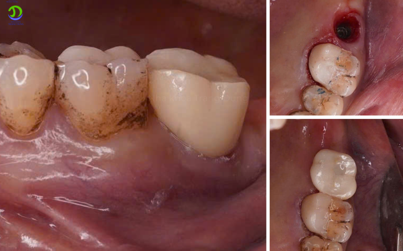 7 Điều Cần Biết Về Tiêu Xương Hàm Và Giải Pháp Ghép Xương Hiệu Quả Tiêu xương hàm