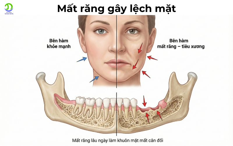 Mất răng gây lệch mặt