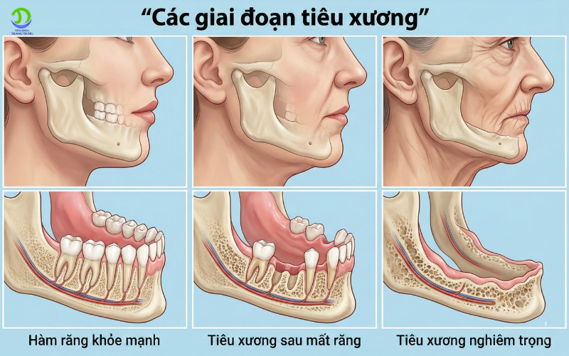 Mất răng gây tiêu xương
