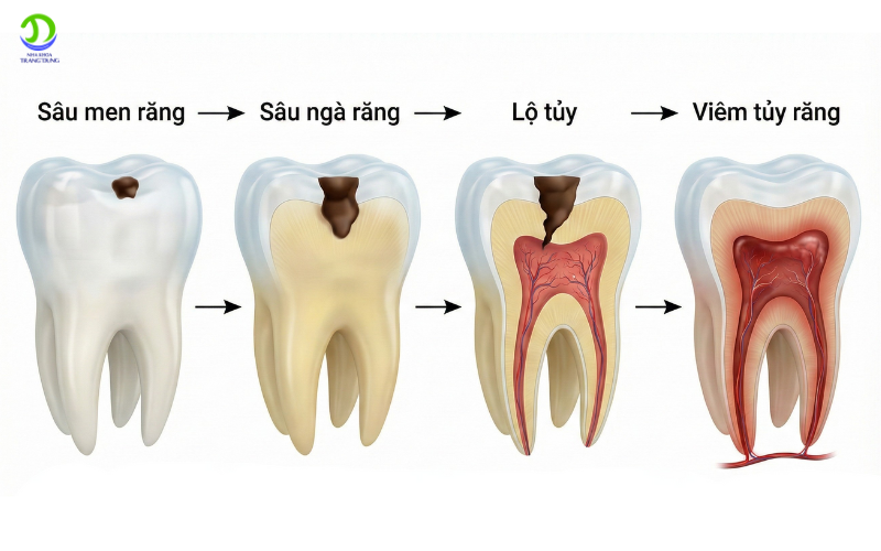 7 mức độ nguy hiểm khi sâu răng tới tủy – Viêm tủy răng có thể gây hậu quả gì? sâu răng