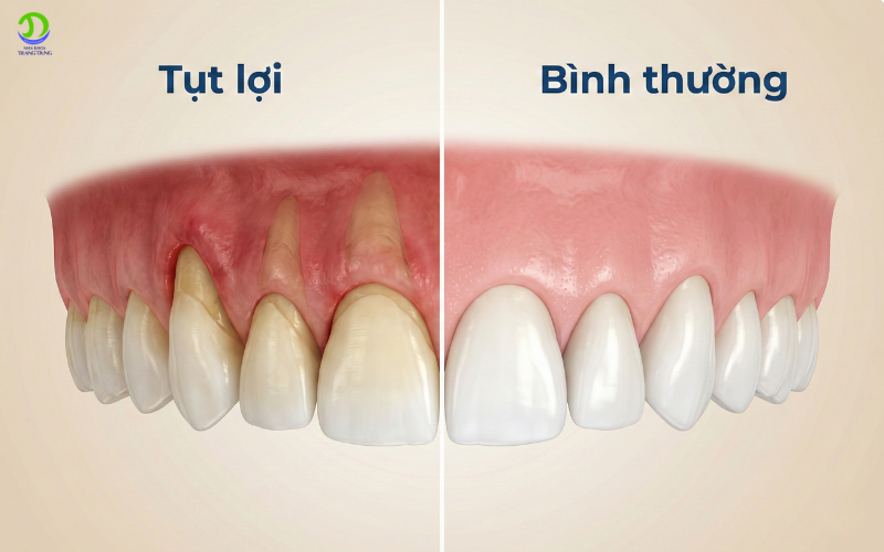 7 sự thật về tụt lợi ở người lớn tuổi: Nguyên nhân, dấu hiệu và cách phòng ngừa hiệu quả tụt lợi