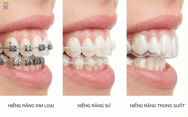 Niềng răng xong có bị chạy lại không? 3 điều cần lưu ý niềng răng