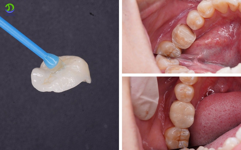 bọc sứ bảo vệ răng điều trị tủy