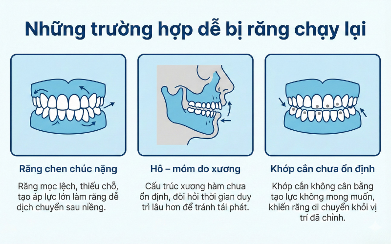 Niềng răng xong có bị chạy lại không? 3 điều cần lưu ý niềng răng xong răng bị chạy lại