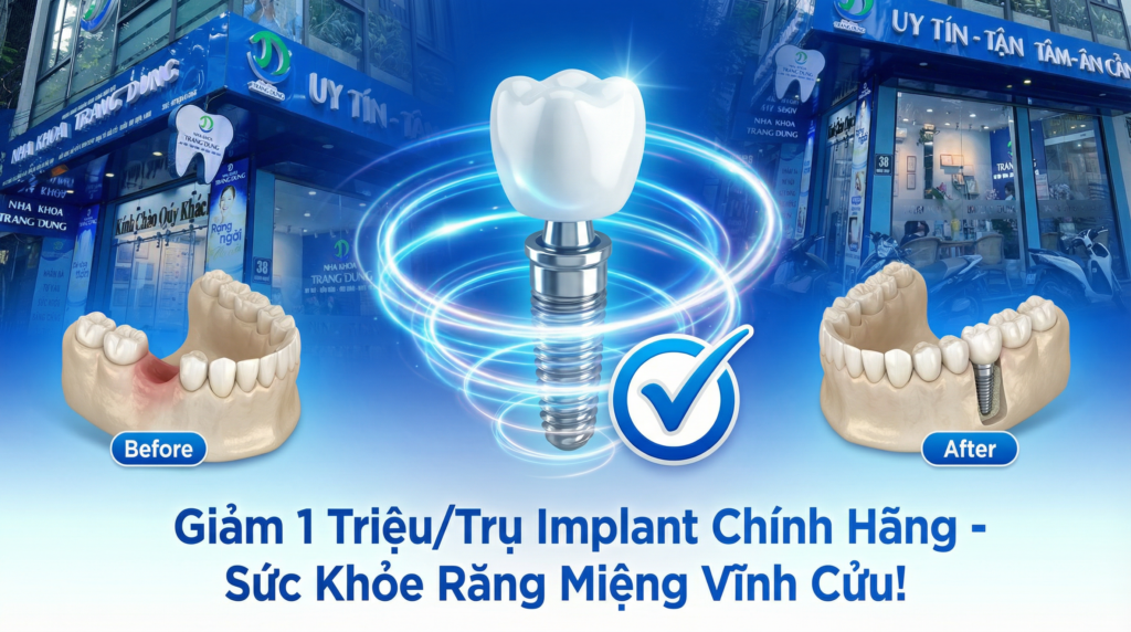 Trồng răng Implant tại nha khoa Trang dung. Ưu đãi implant 38 xuân thuỷ