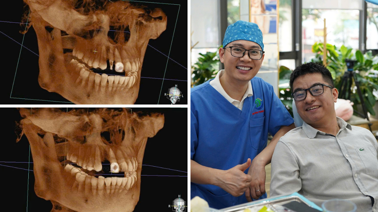 Implant Hàn – Mỹ – Thụy Sĩ khác nhau thế nào? So sánh chi tiết từ A–Z implant