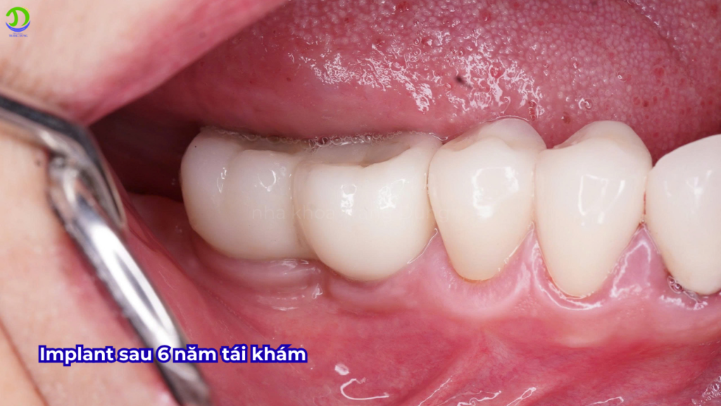 răng sau khi cấp implant 6 năm